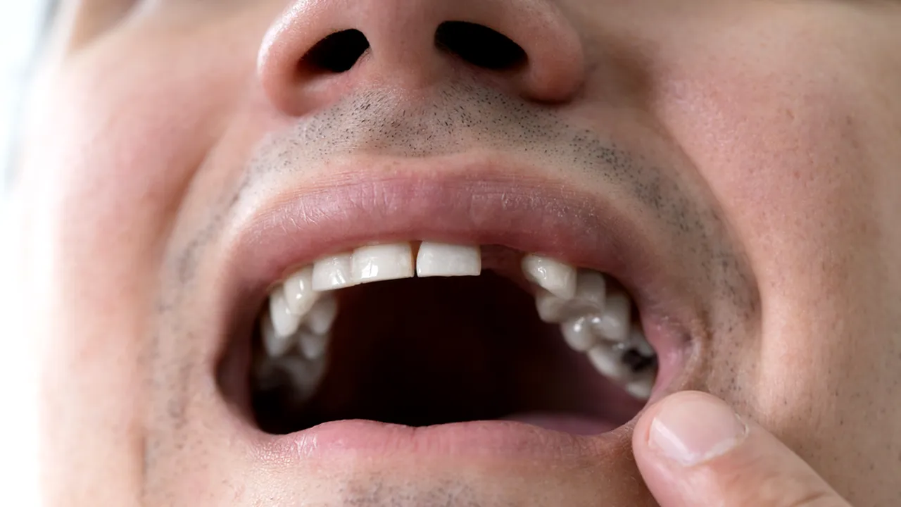 Implanturile dentare şi calitatea vieţii: Cum îmbunătăţesc sănătatea orală şi bunăstarea generală