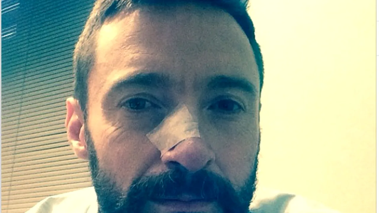 Hugh Jackman a fost operat a doua oară de carcinom bazocelular la nivelul nasului