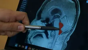 Un bărbat avea dureri mari de cap de câteva luni, iar la un moment dat a leşinat. Medicii au făcut o descoperire terifiantă în craniul lui | VIDEO