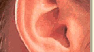 Viermi extraşi din urechea unui pacient aflat într-un centru medico-social