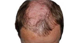 Studiu. Hormonii masculini asociaţi calviţiei ar putea fi motivul numărului ridicat de morţi cauzate de Covid-19 în rândul bărbaţilor