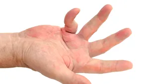 STUDIU Boala Dupuytren ar putea fi tratată. Un medicament utilizat pentru artrita reumatoidă pare să ajute persoanele care au degetele îndoite