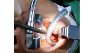 O femeie se plângea de migrene. Când au operat-o, medicii au găsit ceva total neaşteptat în sinusuri | VIDEO