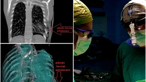 Reuşită medicală în România într-un CAZ RAR: Pacientul avea plămânul ieşit din torace