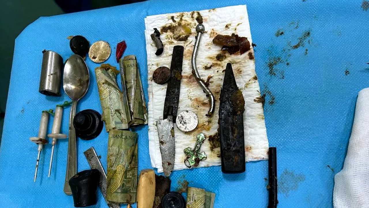 Bani, lamă de cuţit, lingură şi alte obiecte de metal, găsite în stomacul unui pacient din Iaşi