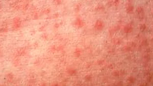 Epidemie de pojar în Statele Unite