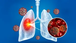 Programe naționale de screening pentru cancerul pulmonar cerute de FABC