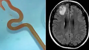 De ce boală suferea femeia în creierul căreia a fost găsit un vierme de 8 centimetri

