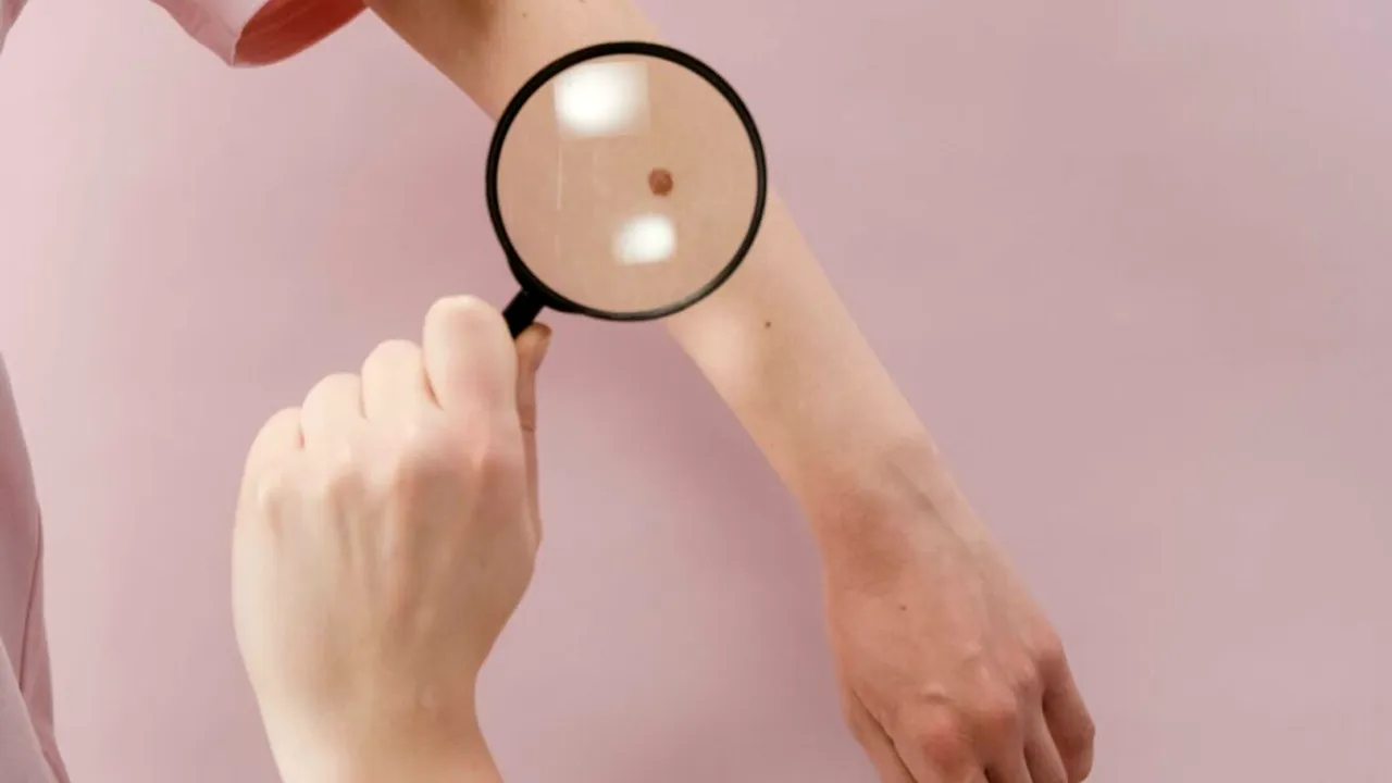 Studiu: Care sunt părțile corpului unde bărbații și femeile dezvoltă cancer de piele