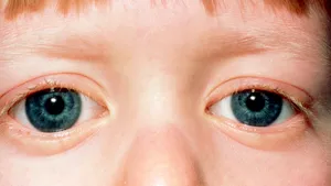 Primul caz de coronavirus, identificat în probe luate din ochii unui copil