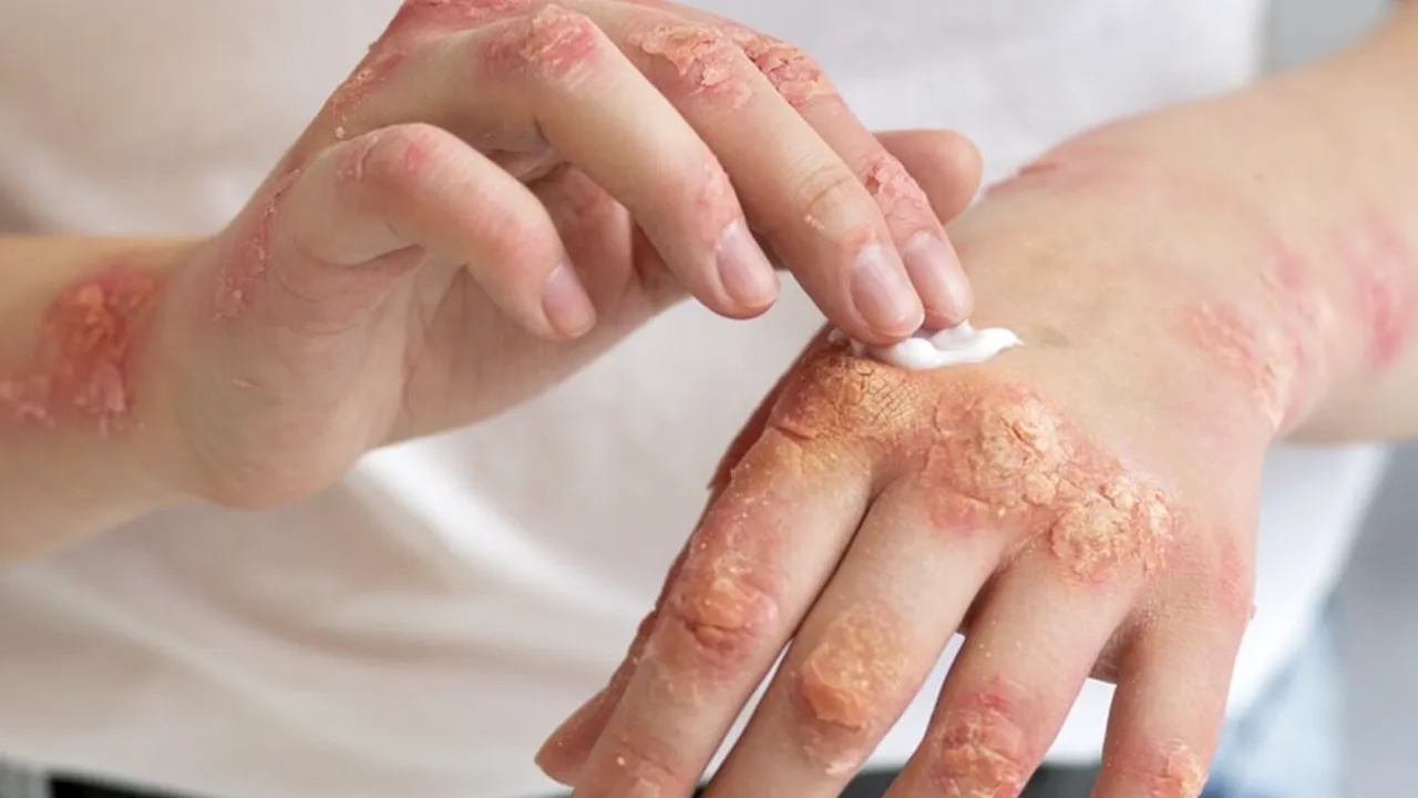 Pielea pierde apă iarna: Sfaturile medicilor pentru protecție