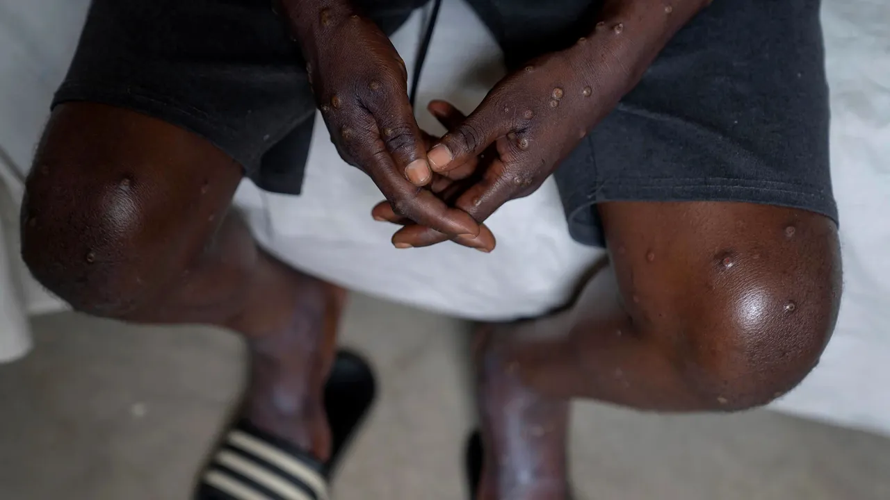 Filipine detectează primul caz de mpox din acest an, dar nu a fost încă determinată tulpina