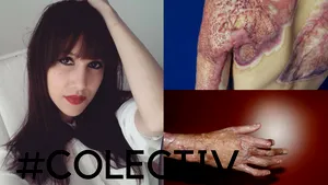 #Colectiv | Alexandra Furnea, o tânără cu sechele care a supravieţuit incendiului şi condiţiilor din spital, îşi deschide acum sufletul: Asistenta, printre lacrimi, cântă o doină. Îmi e frică să nu mor în cada verde