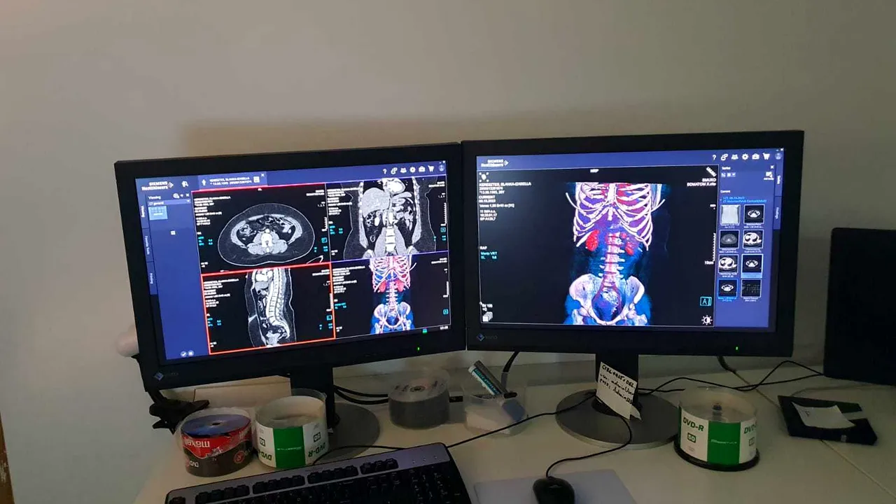 Intervenţie de fixare de bazin cu machetă personalizată 3D, la SCJU Târgu Mureş