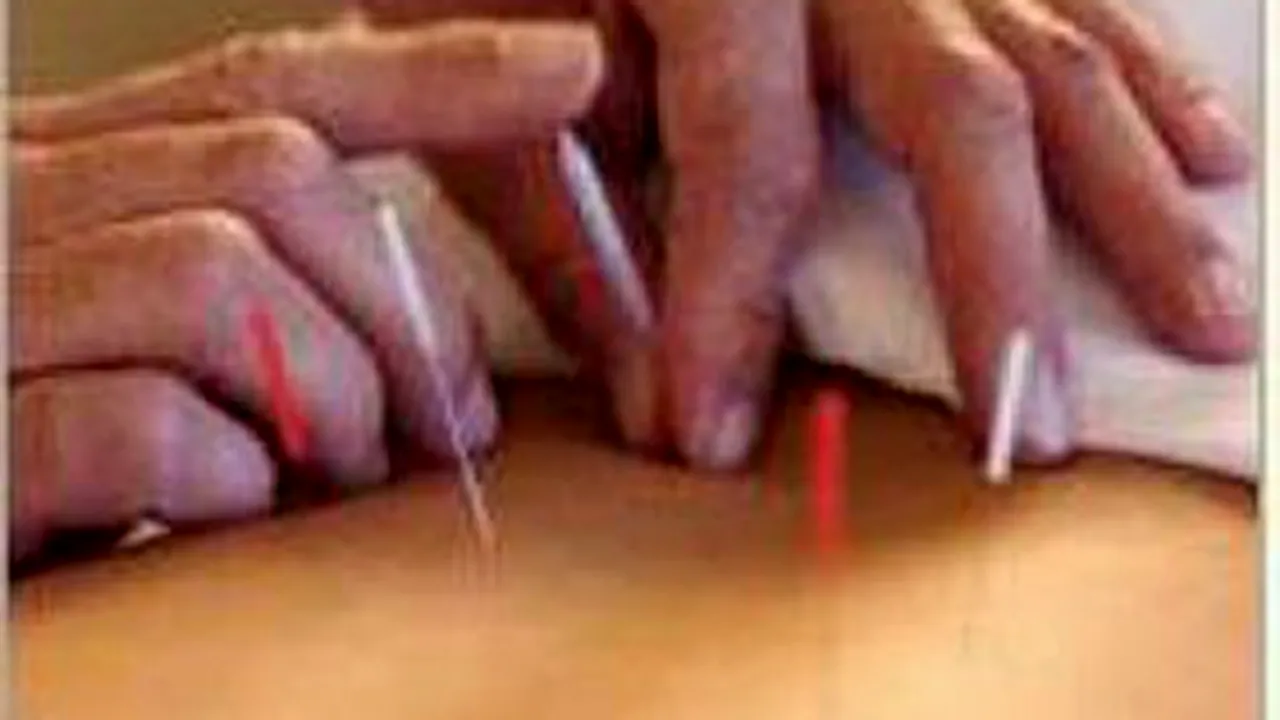 Acupunctura, cea mai eficientă metodă de tratare a durerilor de spate
