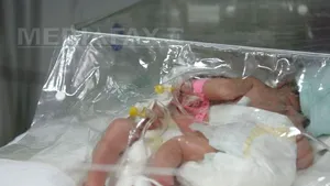 Operaţia de separare a siamezelor din Braşov s-a încheiat cu succes