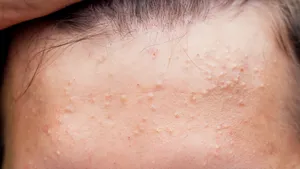 Acid salicilic pentru acnee: protocol complet în 3 pași (P)