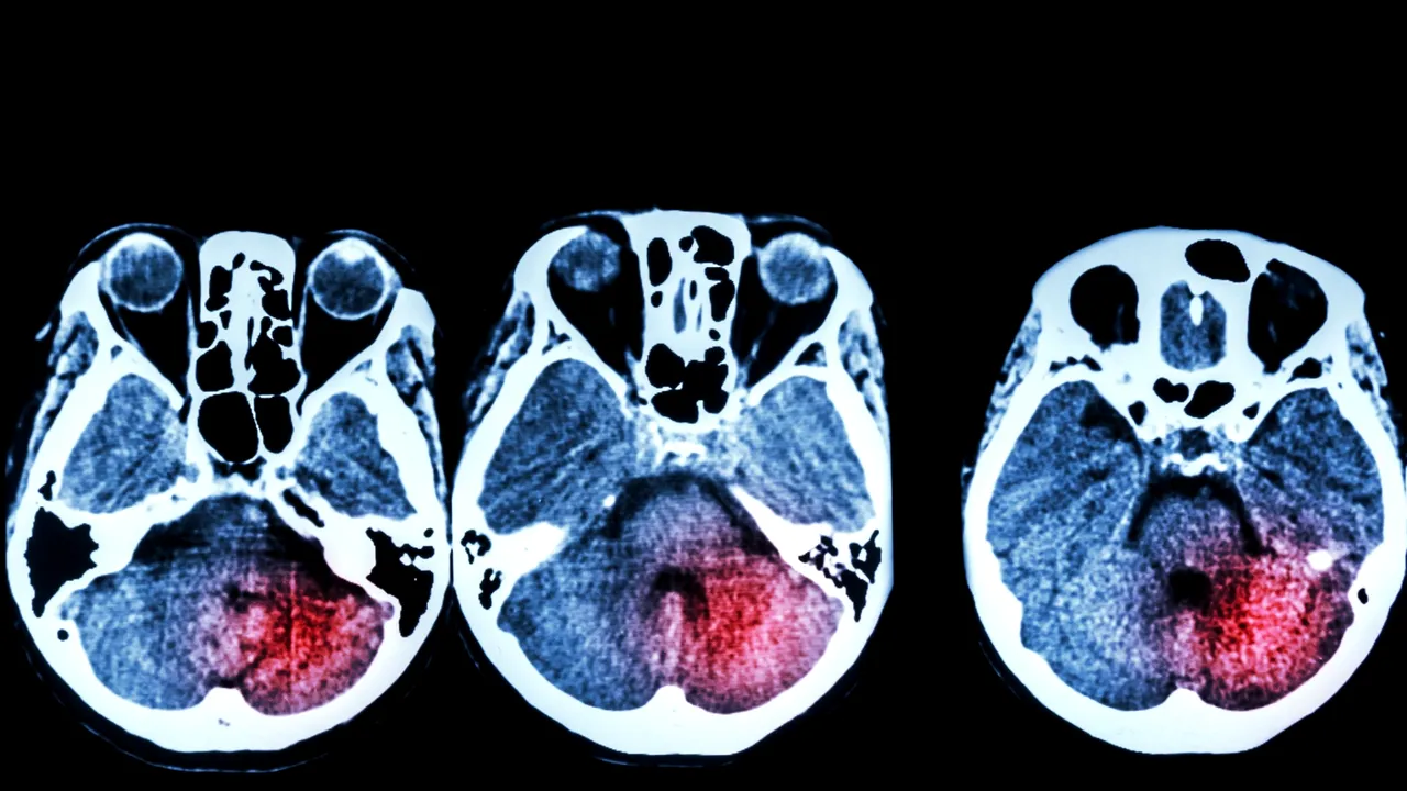 Zilele care îţi salvează viaţa. Cu cât timp înainte apar semnele unui accident vascular cerebral 