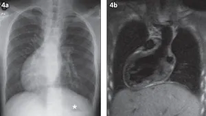 O femeie a trăit 99 de ani fără să ştie că suferea de o afecţiune rară. Doar unul din 50 de milioane de oameni ajunge la vârsta adultă