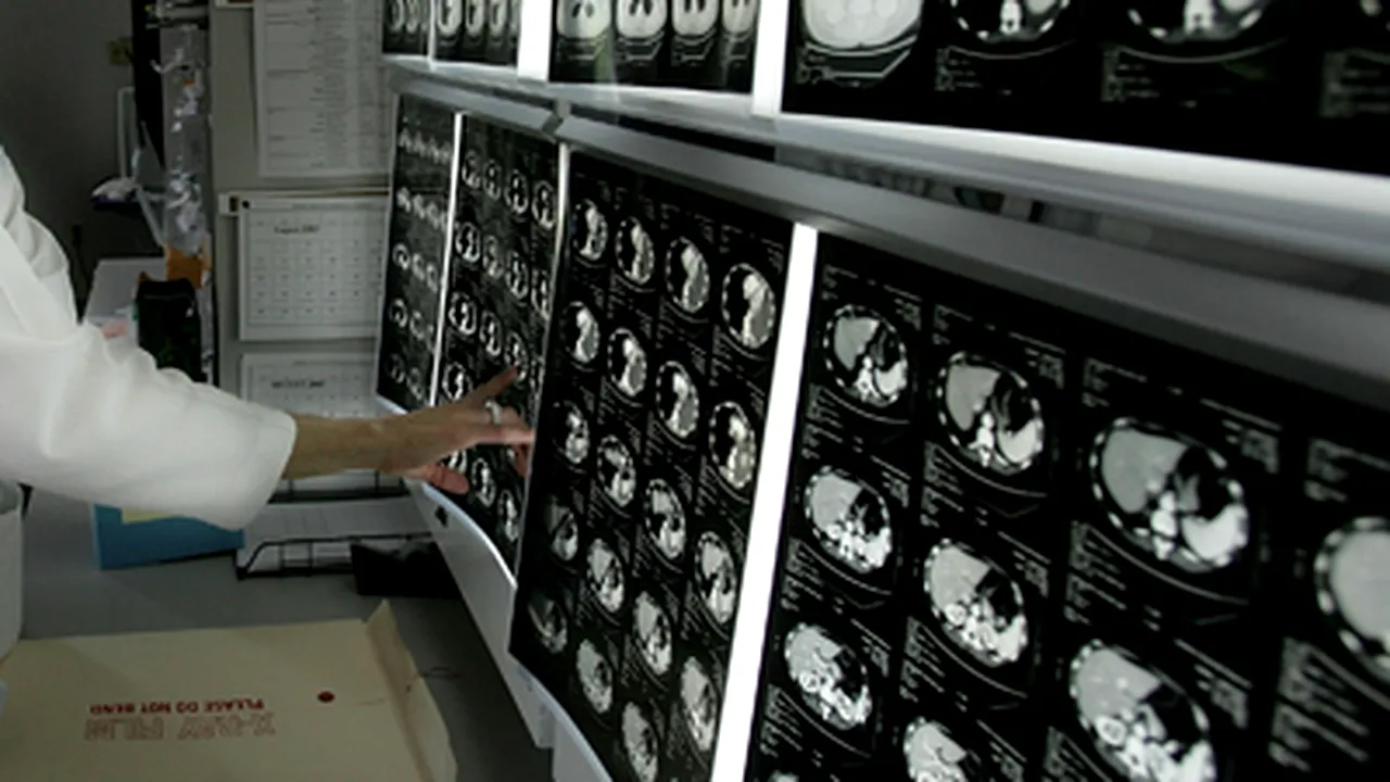 Genele care sporesc riscul de atac cerebral, identificate de cercetători