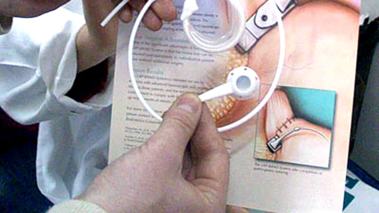 Preţul unui bypass gastric împotriva obezităţii, amortizat în doi ani