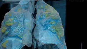 VIDEO 3D. Cum arată plămânii unul bolnav de Covid-19. Noul coronavirus poate distruge mare parte din aceste organe