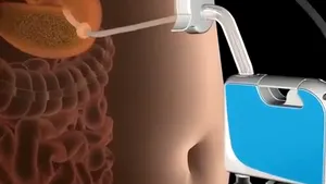 Metodă revoluţionară de slăbit: Cum funcţionează pompa care aspiră mâncarea direct din stomac - VIDEO