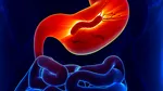 O bacterie uitată ar putea cauza 15 milioane de cazuri de cancer