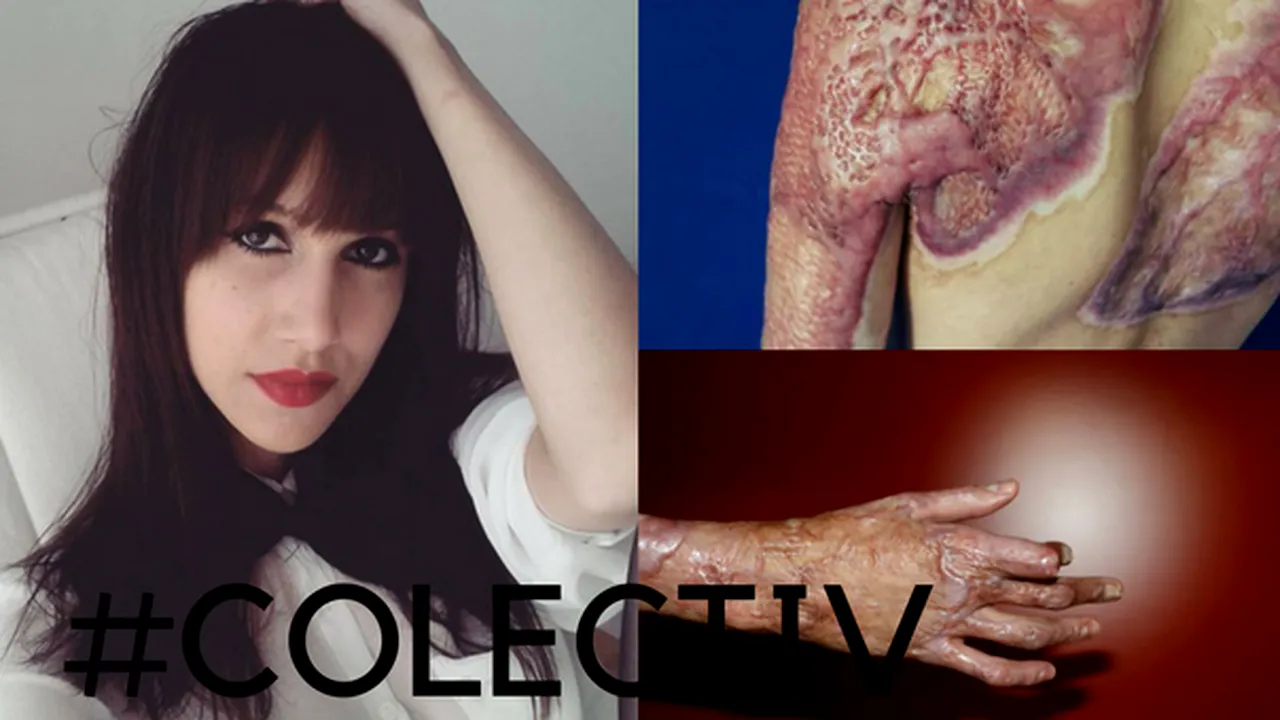 #Colectiv | Alexandra Furnea, o tânără cu sechele care a supravieţuit incendiului şi condiţiilor din spital, îşi deschide acum sufletul: Asistenta, printre lacrimi, cântă o doină. Îmi e frică să nu mor în cada verde